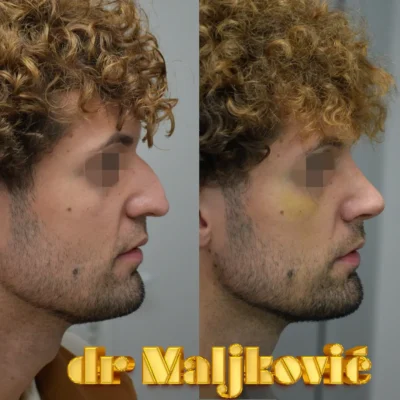 Rinoplastika u Beogradu, operacija nosa kod muskarca - Dr Igor Maljkovic - pogled sa strane-2