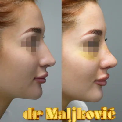 Rinoplastika u Beogradu, operacija nosa - Dr Igor Maljkovic - pogled sa strane