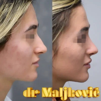 Operacija nosa u Beogradu, saznajte cenu kod dr Igora Maljkovica - slike pre i posle - pogled sa strane - 2