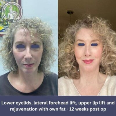 Medic Hill bolnica - Zatezanje lica slike pre i posle - pogled s preda - 12 sedmica posle operacije