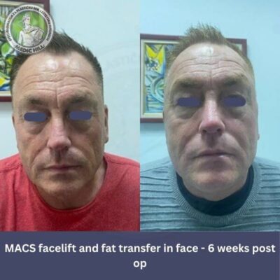 Medic Hill bolnica - Zatezanje lica slike pre i posle MACS metoda - pogled spreda - 6 sedmica posle