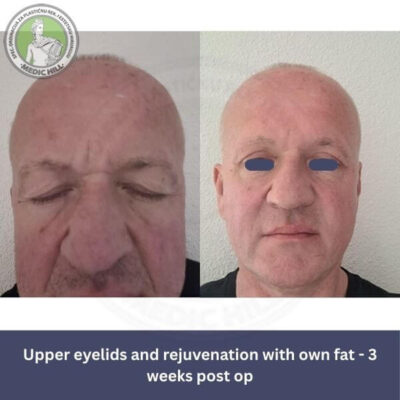 Podizanje gornjeg dela očiju sa podmlađivanjem u bolnici Medic Hill, muška procedura pre i posle - pogled sa prednje strane 3 nedelje nakon operacije