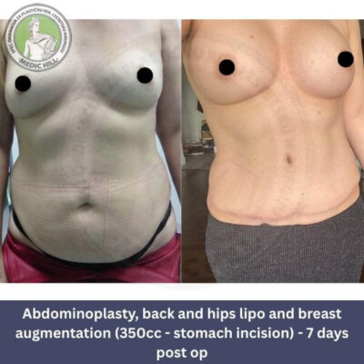 Abdominoplastika u Medic Hill bolnici u Beogradu, prof. dr Milan Filipovic slike pre i posle - pogled s preda