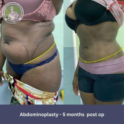 Zatezanje kože stomaka u Medic Hill bolnici u Beogradu, prof. dr Milan Filipovic slike pre i posle - pogled iskosa - 5 meseci posle operacije