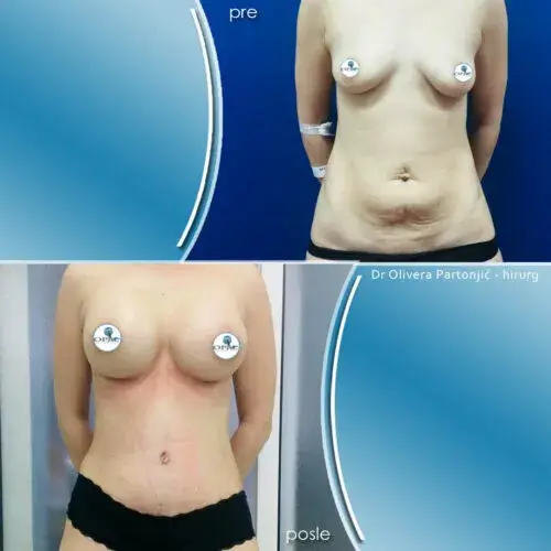 Mommy makeover u Srbiji – kombinovana operacija posle porođaja, Beograd