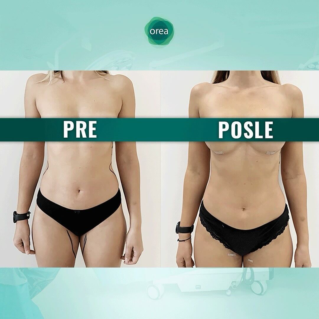 Lipofiling grudi cena Beograd – prirodno povećanje grudi rezultat