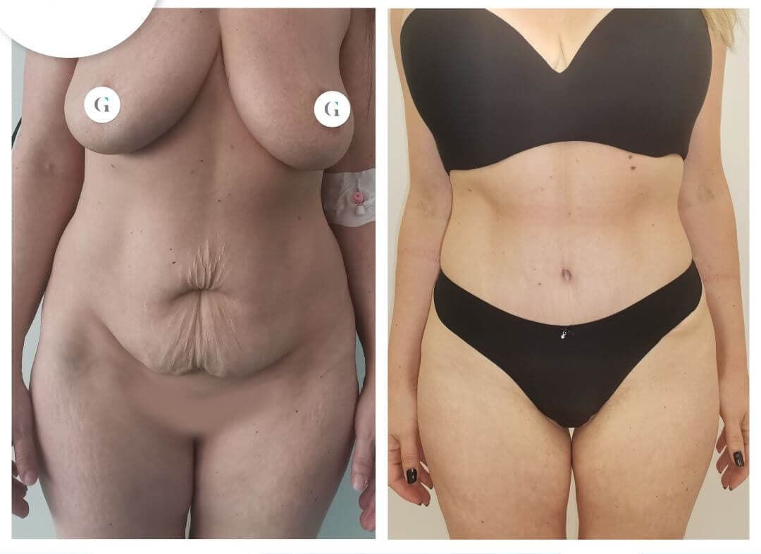 Abdominoplastika cena Beograd – rezultat zatezanja stomaka, Srbija